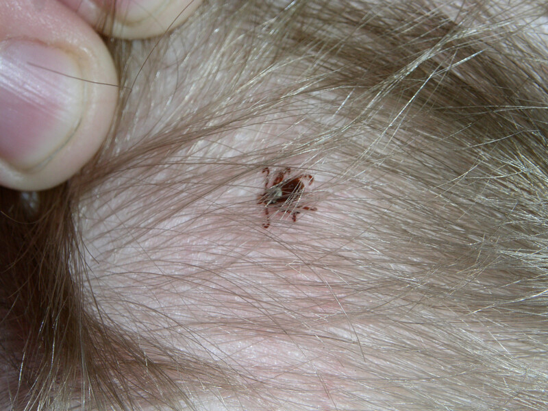 FAQ tick bite through clothing Do Ticks Hide in Hair