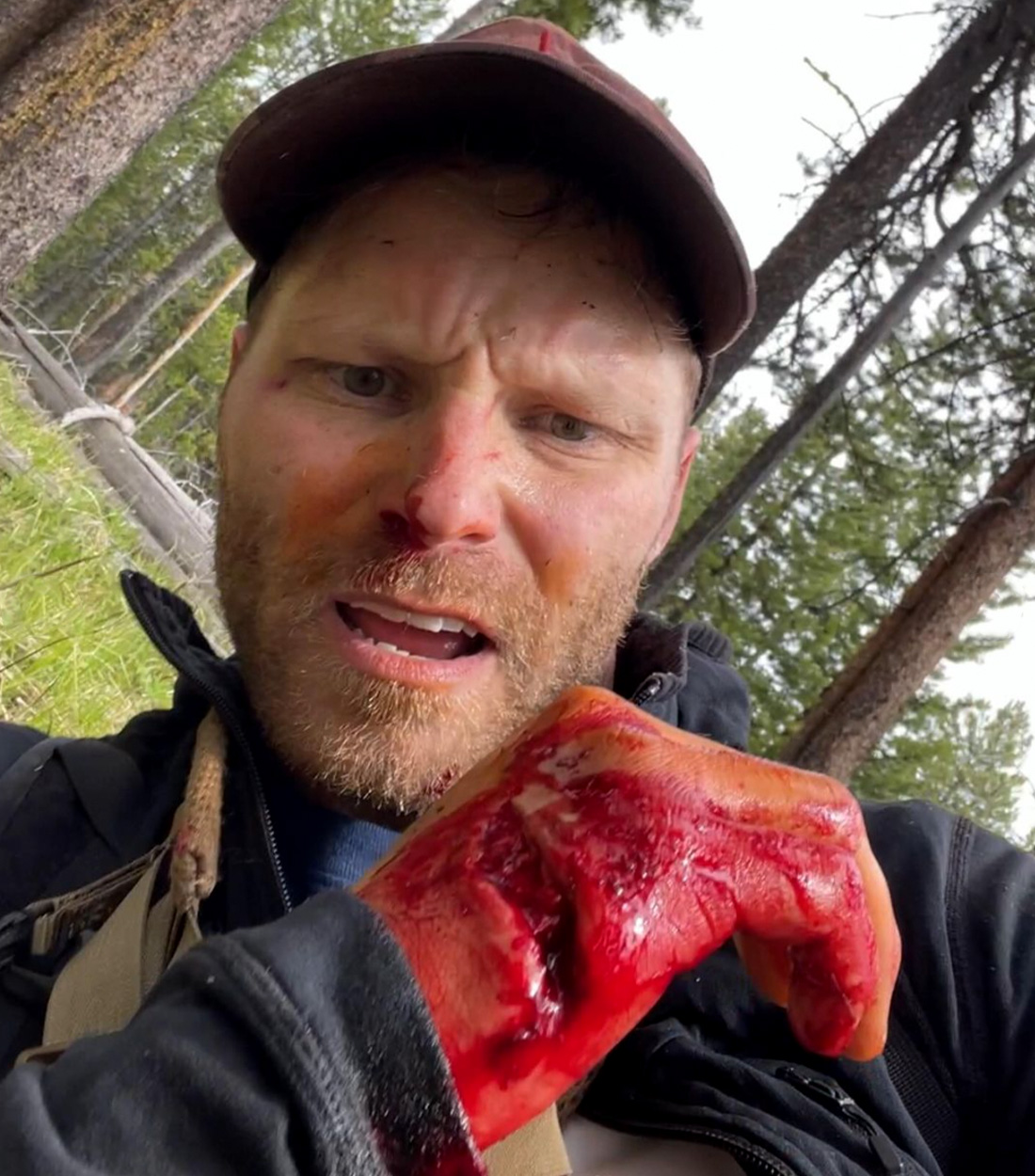 Grizzly bear attack victim shows his wound.